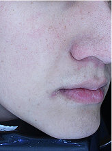 레이저토닝+줌패스3회