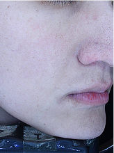 레이저토닝+줌패스3회