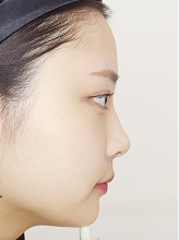 코실리프팅+이마필러+입술필러