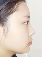 코실리프팅+이마필러+입술필러