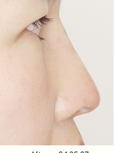 콧대+코끝실리프팅