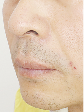 팔자필러+볼륨실