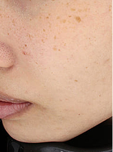 피코플러스+더블엑셀브이+피코슈어+줌패스