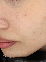 피코플러스+더블엑셀브이+피코슈어+줌패스