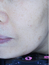 피코슈어+줌패스