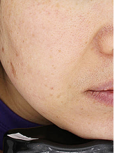 색소 기미+콜라겐레이저